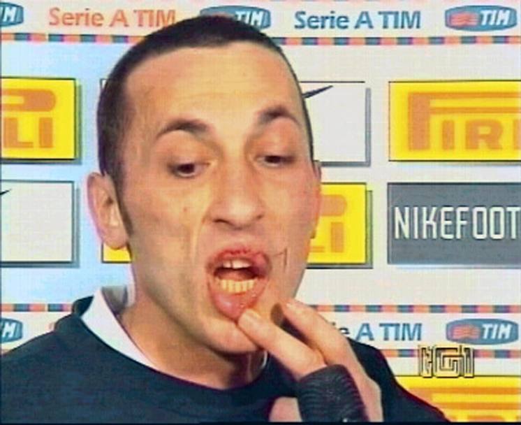 Cirillo mostra in tv i segni del pugno ricevuto da Materazzi durante Inter-Siena del 2004 (Rai)